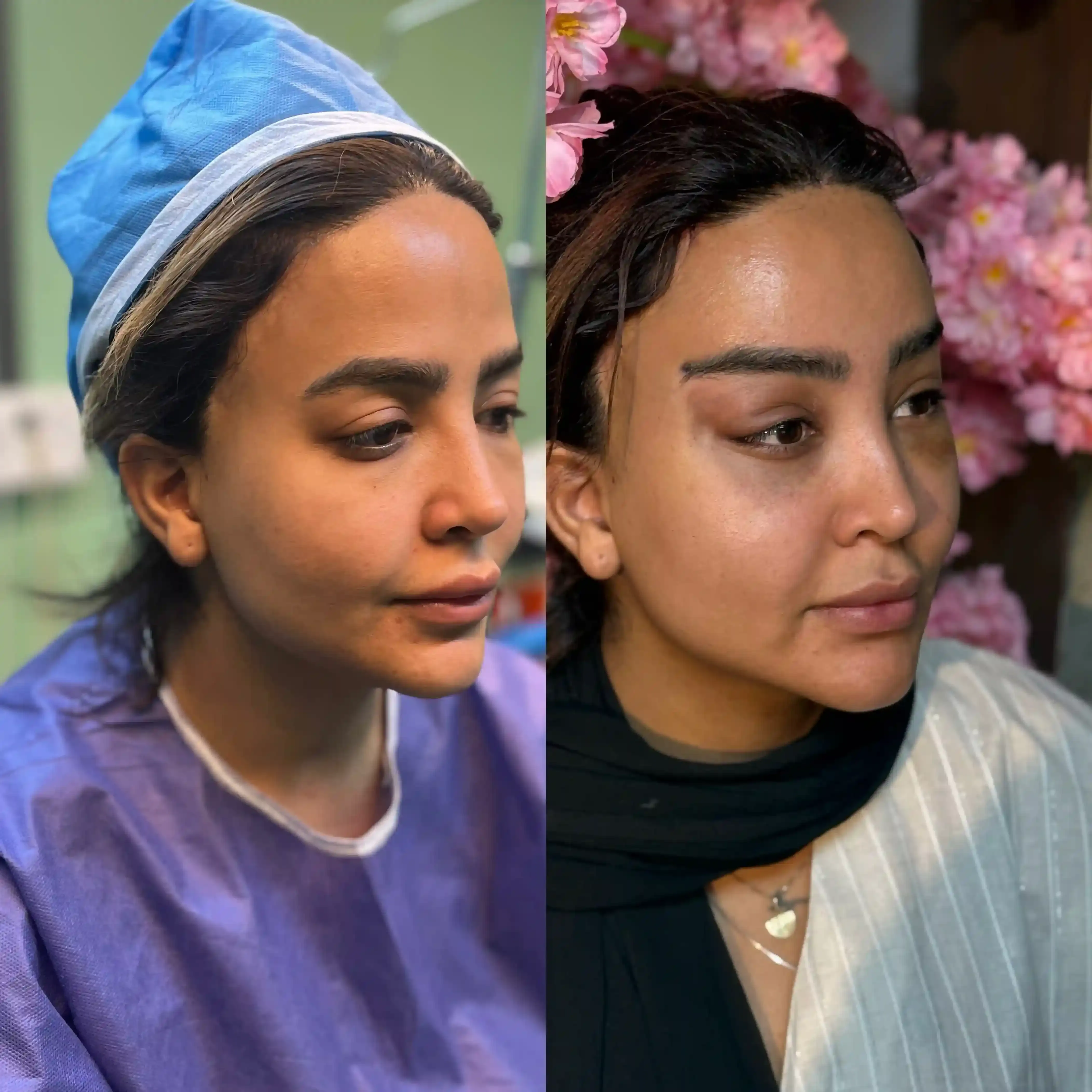 نمونه کار لیفت صورت